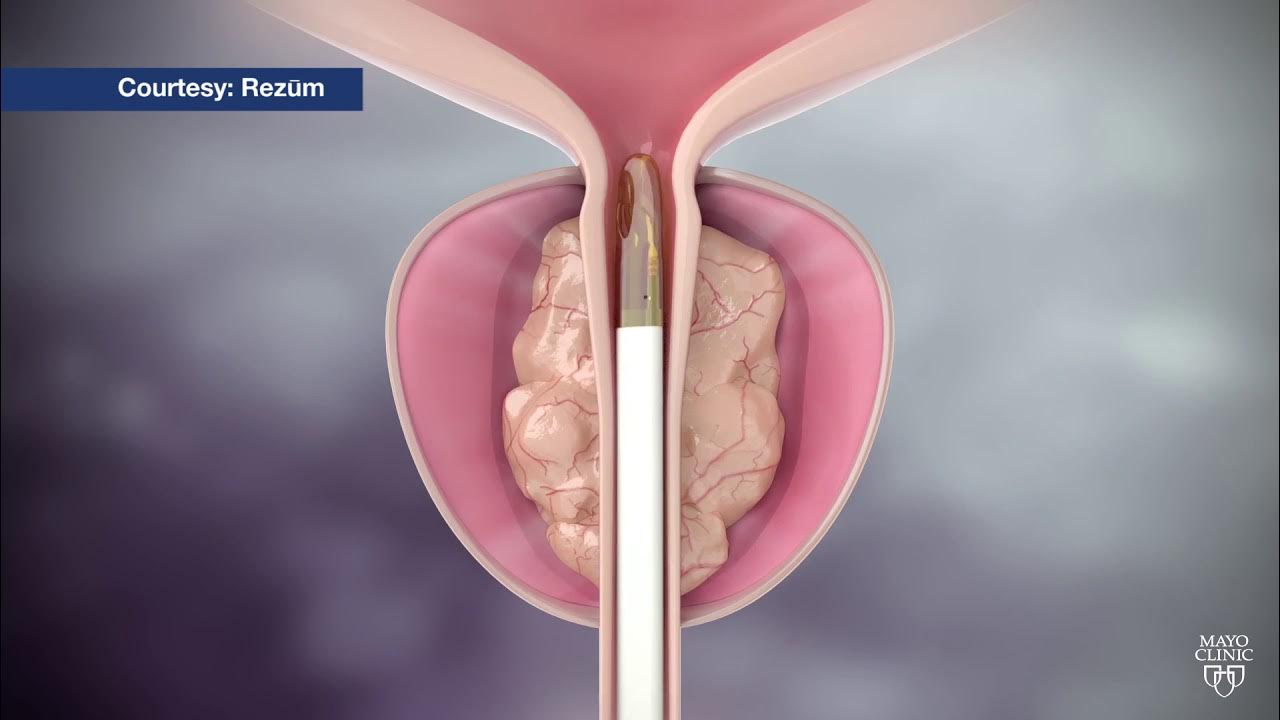 PROSTATE ENLARGEMENT THERAPY