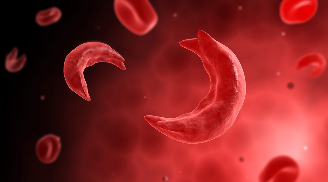 SICKLE CELL THERAPY